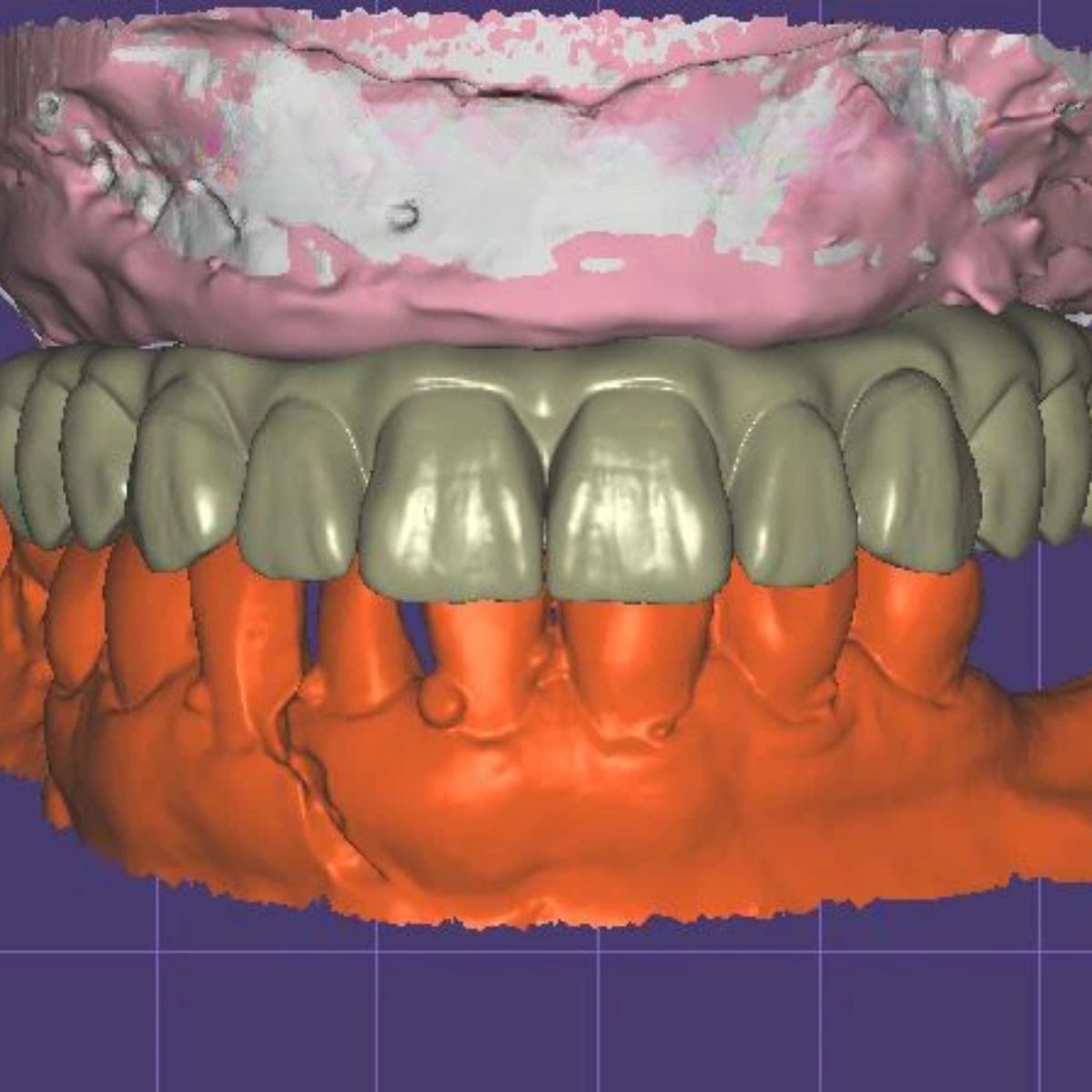 all-on-x-implant-design-cad-service All-on-X implant design with multiple implant configurations CAD/CAM digital file ready for production