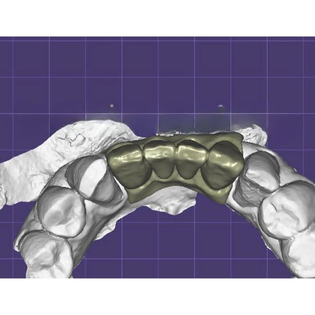 Cement Retained Implant Bridge Design | CAD/CAM Service