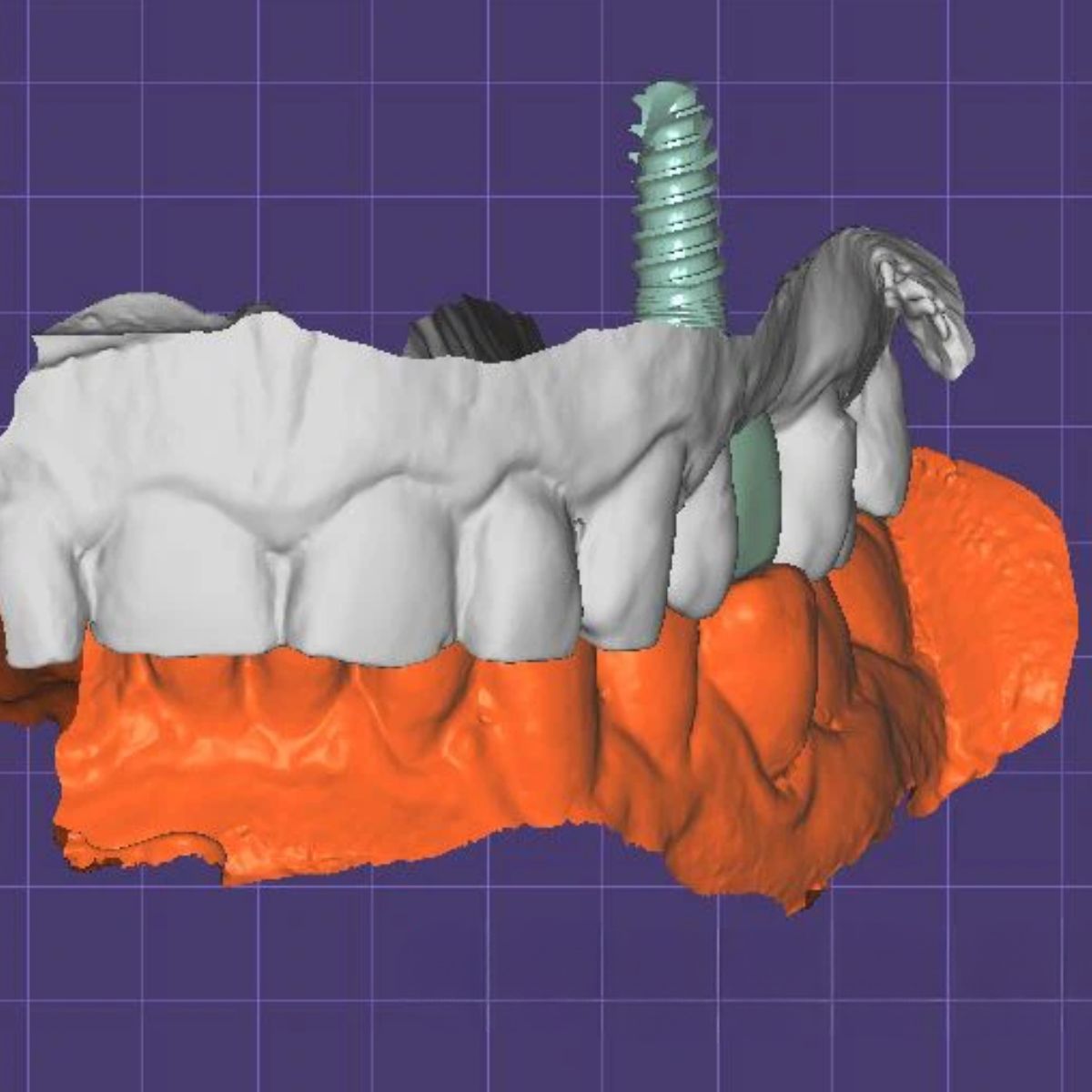Cement Retained Implant Crown Design | CAD/CAM Service