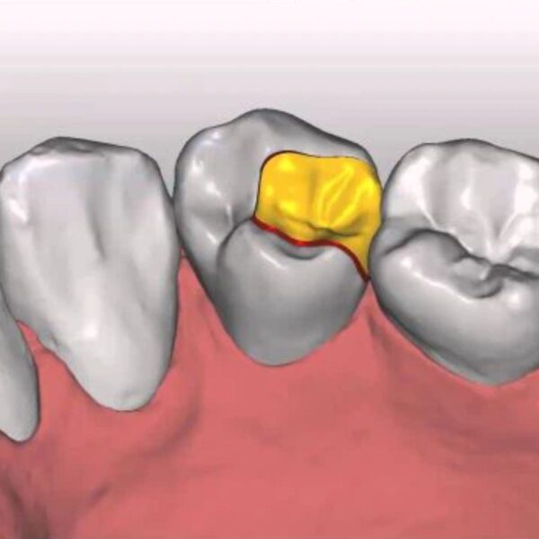 Professional dental inlay design CAD file showing precise conservative restoration with optimal marginal fit